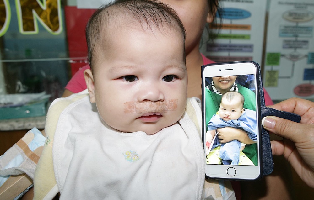 Baby with a cleft lip held by her mother, who shows a photo on her phone